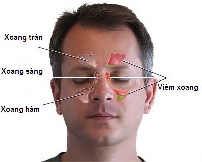 Triệu chứng và cách trị viêm xoang sàng sau